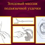 Massage of the hyoid frenulum using probes