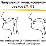 Разновидности ламбдацизма