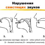 Stigmatism of hissing sounds